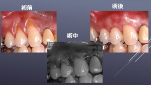 根面被覆２症例